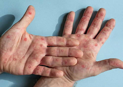 Hands with monkeypox